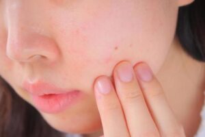 肌トラブルを起こしている女性の顔